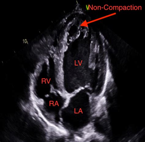 noncompaction cardiomyopathy echo